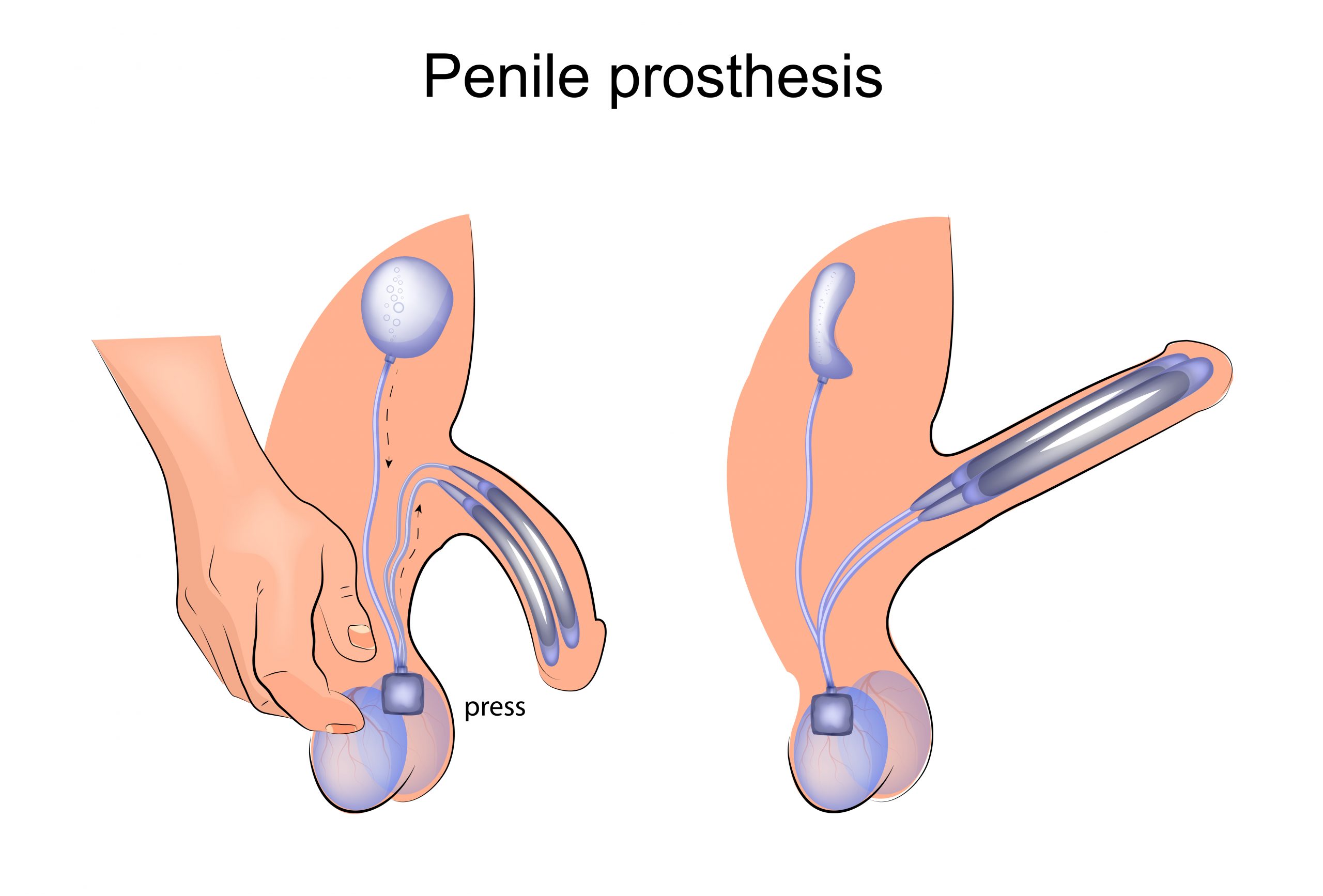 ERECTILE DYSFUNCTION