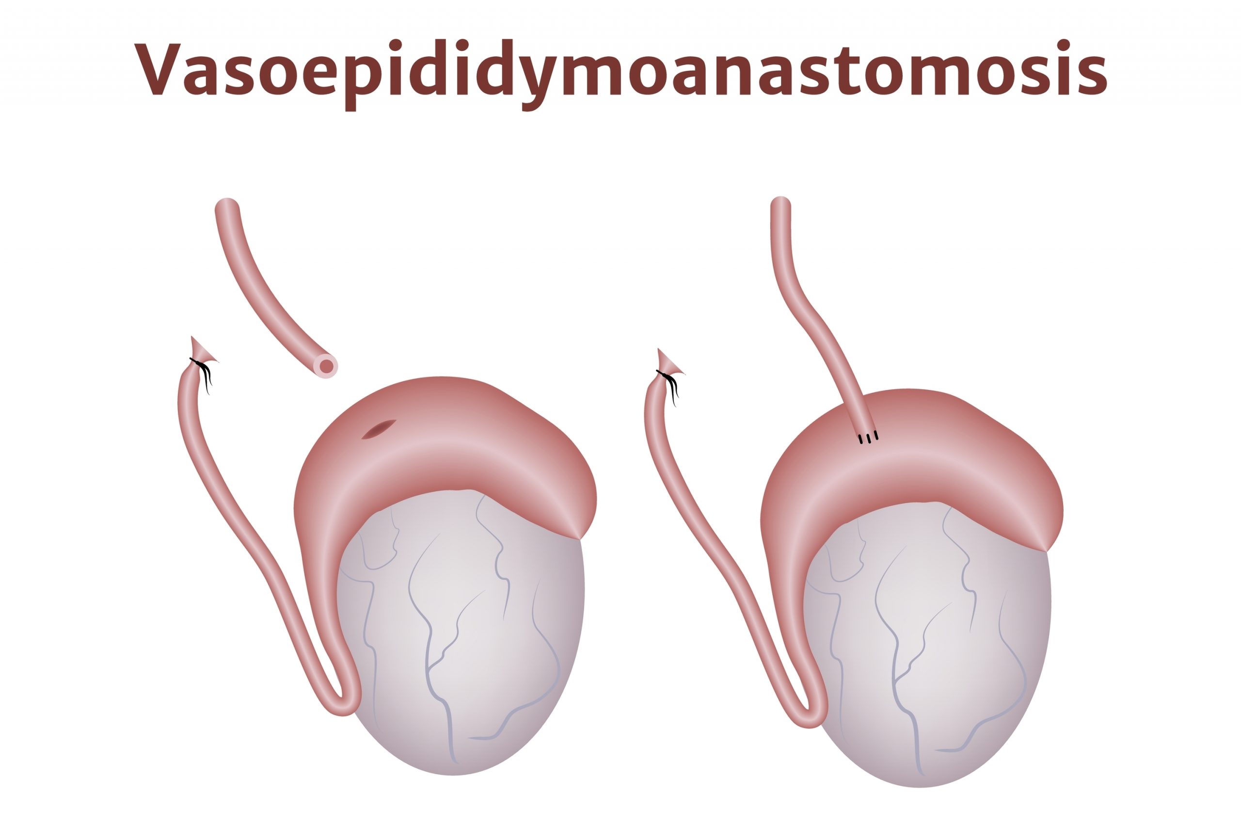VASECTOMY REVERSAL
